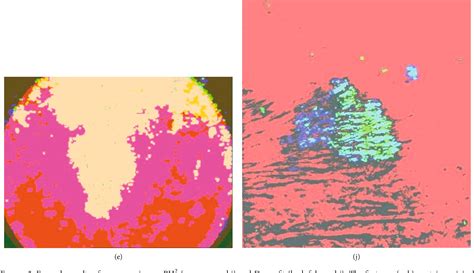 Figure 3 From A Segmentation Of Melanocytic Skin Lesions In Dermoscopic