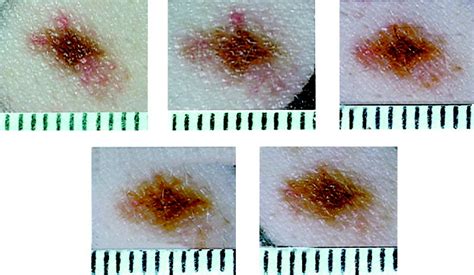 Dysplastic Nevus Vs Melanoma Pictures