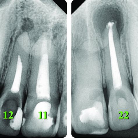 Preoperative Radiographs Of A Year Old Female Who Was Referred For