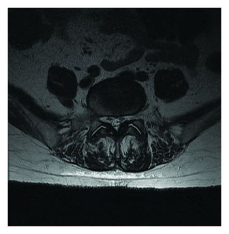 Axial T2 Weighted Mri Images Showing Sequential Cuts Ad Download Scientific Diagram