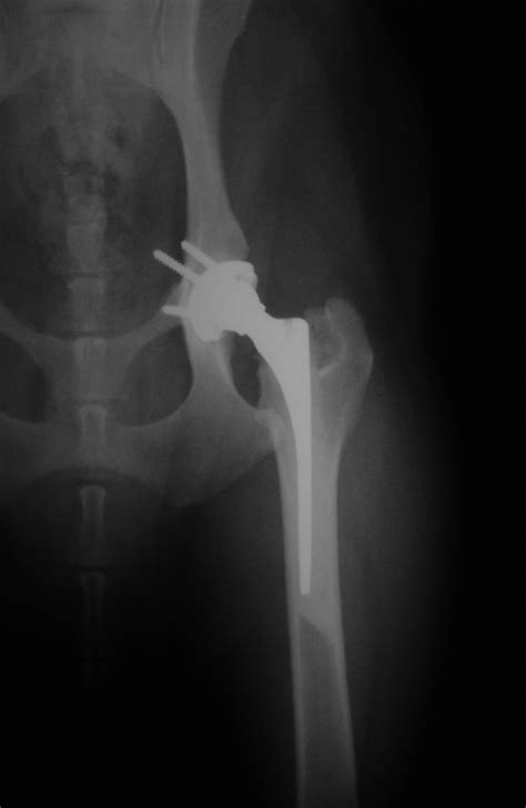 Ventrodorsal Postoperative Radiograph After Implantation Of A Modular