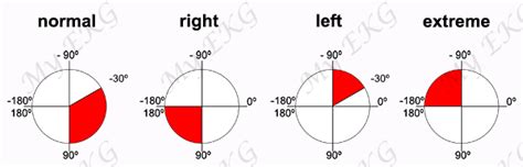 EKG Axis Map