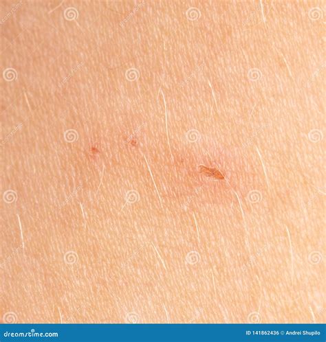 Wound On Human Skin As A Background Stock Photo Image Of Wound