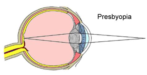 Presbyopia Signs Causes Treatment And Prevention