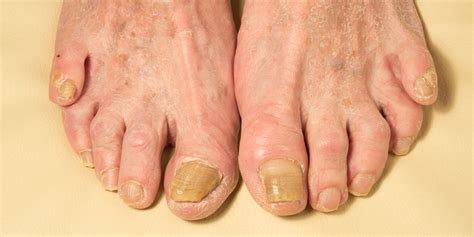 Understanding Fungal Nail Infections And Effective Treatment Stand