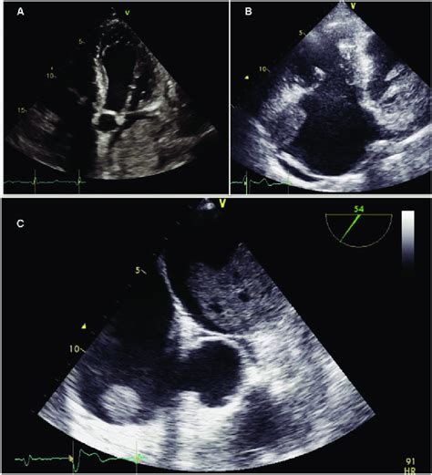 A Transthoracic Echocardiography Showing A Large Left Atrial Mass