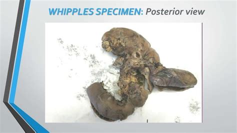 Whipples Specimen Grossing