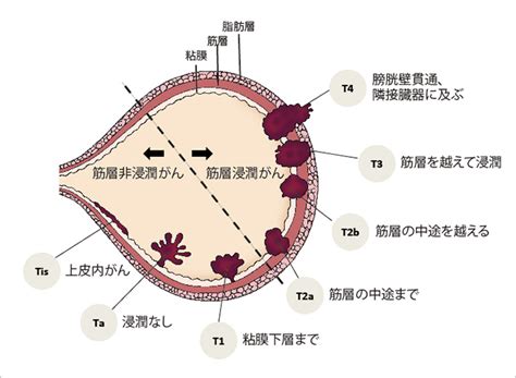 膀胱がん｜がんの先進医療｜蕗書房