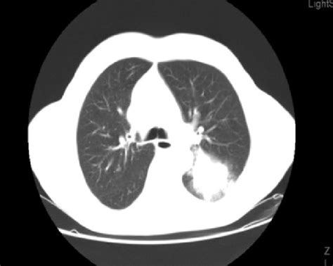 Computed Tomography Scan Of The Chest Prior To Erlotinib Treatment