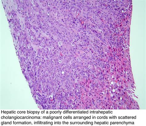 Pathology Outlines Intrahepatic Cholangiocarcinoma Small And Large