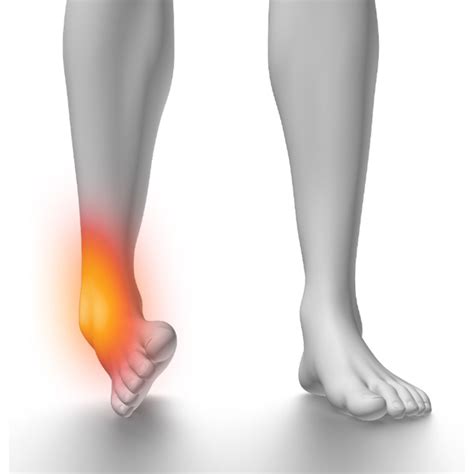 Lateral Ankle Sprain Body Boronia