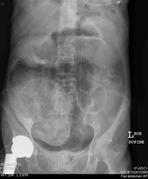 Bowel Perforation Statpearls Ncbi Bookshelf