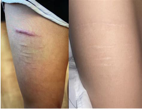 Self Harm Scar Treatment Dr Nina Wines North Shore Laser And