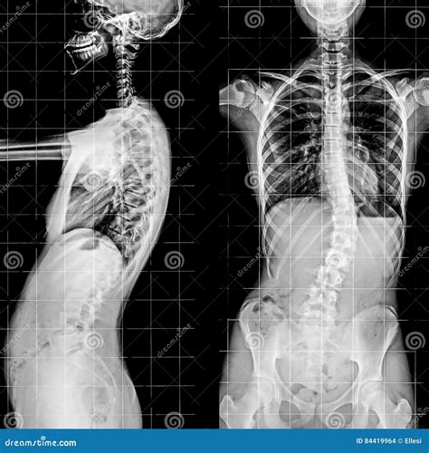 X Ray Of The Spinal Column And Pelvis Stock Photo Image Of Xray