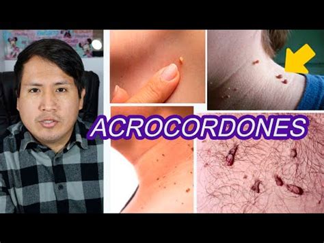 ACROCORDONES EN CUELLO FIBROMAS BLANDOS YouTube