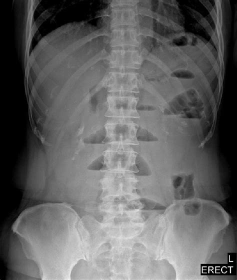 Upright Abdominal Radiograph Showing Multiple Air Fluid Levels