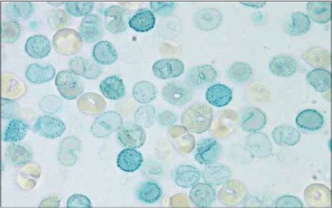 Reticulocyte Supravital Stain