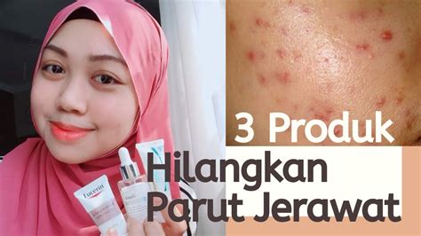 3 Produk Untuk Hilangkan Parut Jerawat Menjadi Youtube