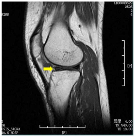 Expression Of Synovial Fluid Biomarkers In Patients With Knee