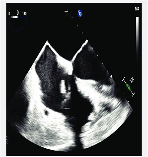 TEE after procedure. Significant reduction (>80%) of vegetations ...