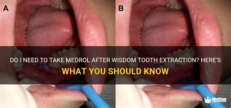 Do I Need To Take Medrol After Wisdom Tooth Extraction Heres What You Should Know Medshun