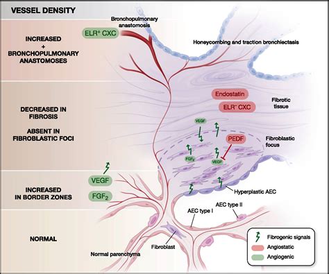 Angiogenesis In Pulmonary Fibrosis Chest