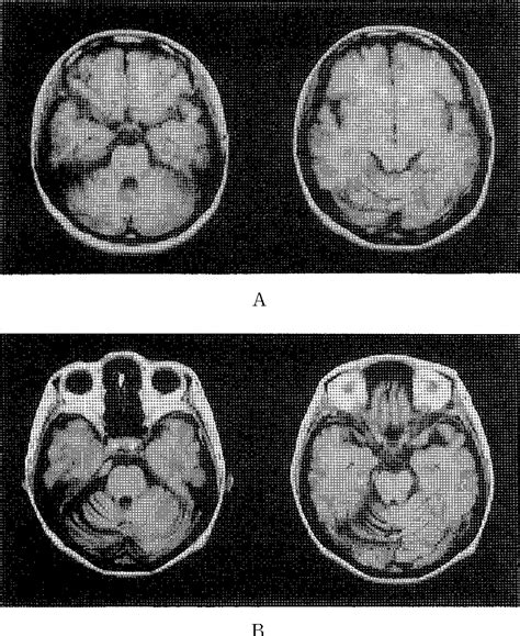 Figure 1 From Stiff Person Syndrome Associated With Cerebellar Ataxia And High Glutamic Acid