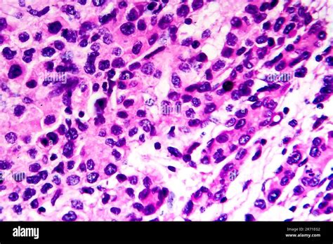 Hepatocellular Carcinoma Cancer Of Liver Light Micrograph Photo Under Microscope High