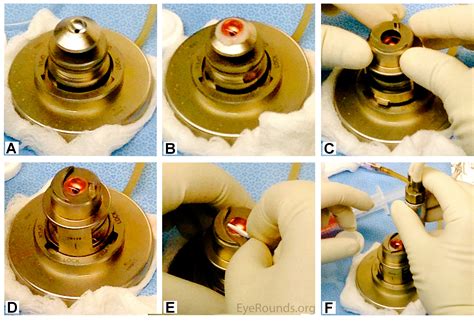 Corneal Transplantation From Donor To Recipient