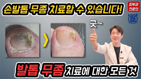 발톱무좀 치료 피부과 전문의가 알려드립니다 발톱무좀약발톱무좀레이저발톱무좀제거 닥터피부광 Youtube