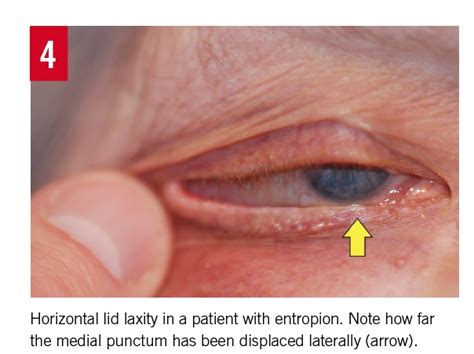 Entropion Etiology Classification Diagnosis And Treatment