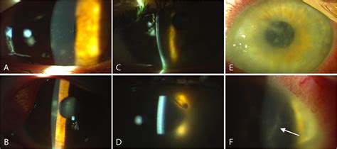 Early Acanthamoeba Keratitis