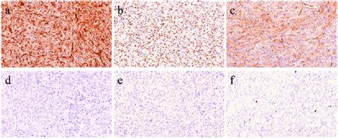 Immunohistochemical Findings Of The Cellular Solitary Fibrous Tumor