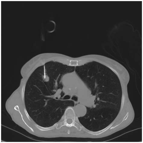 Imaging Of Computed Tomography Guided Transthoracic Core Needle Biopsy Download Scientific