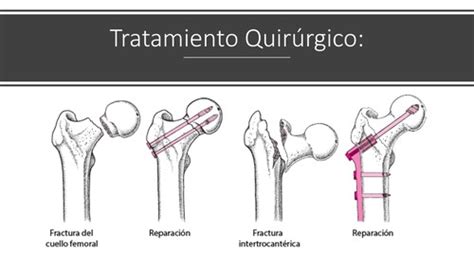 Fichas De Aprendizaje Fractura De Cadera Quizlet