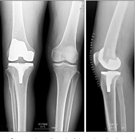 Figure 1 From Compartment Syndrome Of The Thigh Following Manipulation