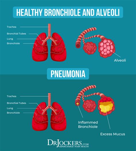 Pneumonia: Causes, Symptoms & Support Strategies | Pneumonia, Pneumonia symptoms, Healing solutions