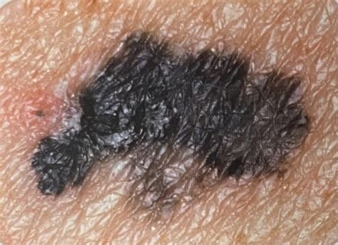 IS THAT MOLE A MELANOMA? | Colorado Dermatology Center Blog