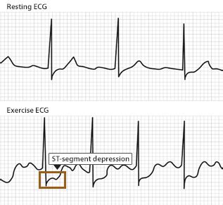 Ecg During Exercise