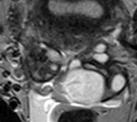 MRI of Endometriosis - RAD-ASSIST