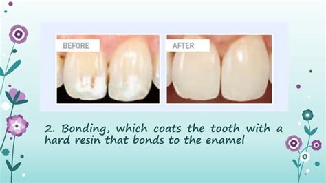 Dental Fluorosis | PPT