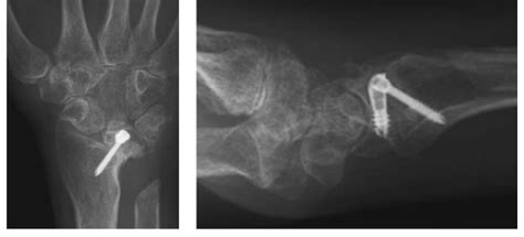 How to diagnose and treat a Palmar Midcarpal Instability