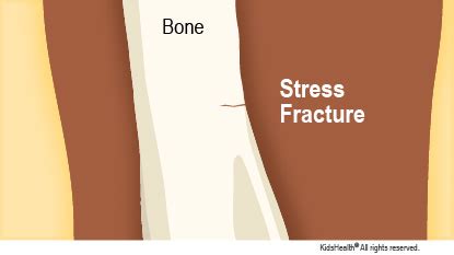 Ulna Hairline Fracture