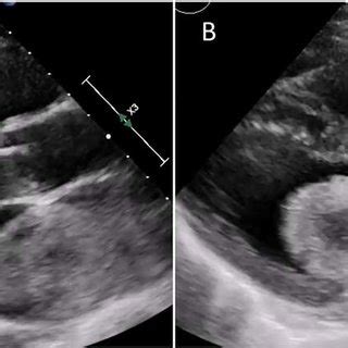 Transthoracic Echocardiogram During Systole A And Diastole B Giant