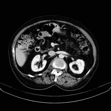 Radiopaedia Case Aging Fatty Replacement Of The Pancreas Id 27501