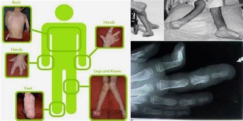 Proteus Syndrome - Assignment Point