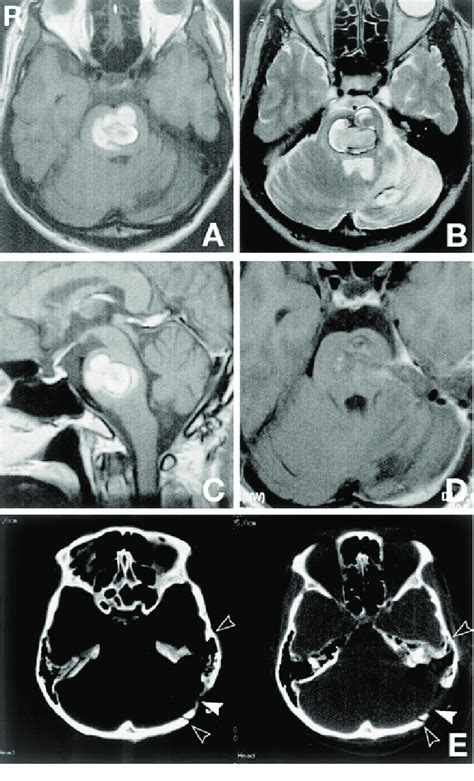 Case 2 A Preoperative Axial T 1 Weighted Magnetic Resonance MR