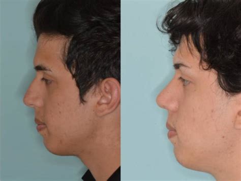 24 Year Old Man Treated With Rhinoplasty Nose Surgery With Dr Bared