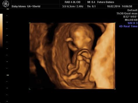 10 Weeks Pregnant Ultrasound Twins