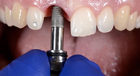 Ensuring Successful Implant Maintenance Dimensions Of Dental Hygiene